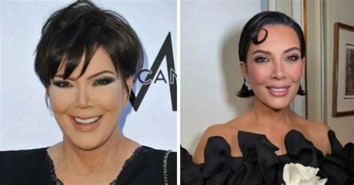 Kris Jenner’s Recent Plastic Surgery: Expert Analysis